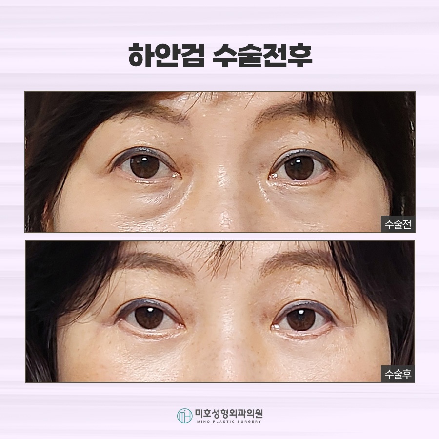 상하안검수술 처진 눈꺼풀 개선 방법 관련 이미지 10