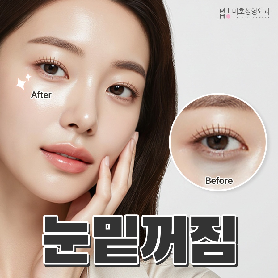 눈밑꺼짐 원인에 맞게 관련 이미지 1