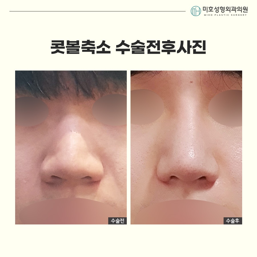 How to Make Your Nostrils Look Smaller: Considering Facial Harmony image 7