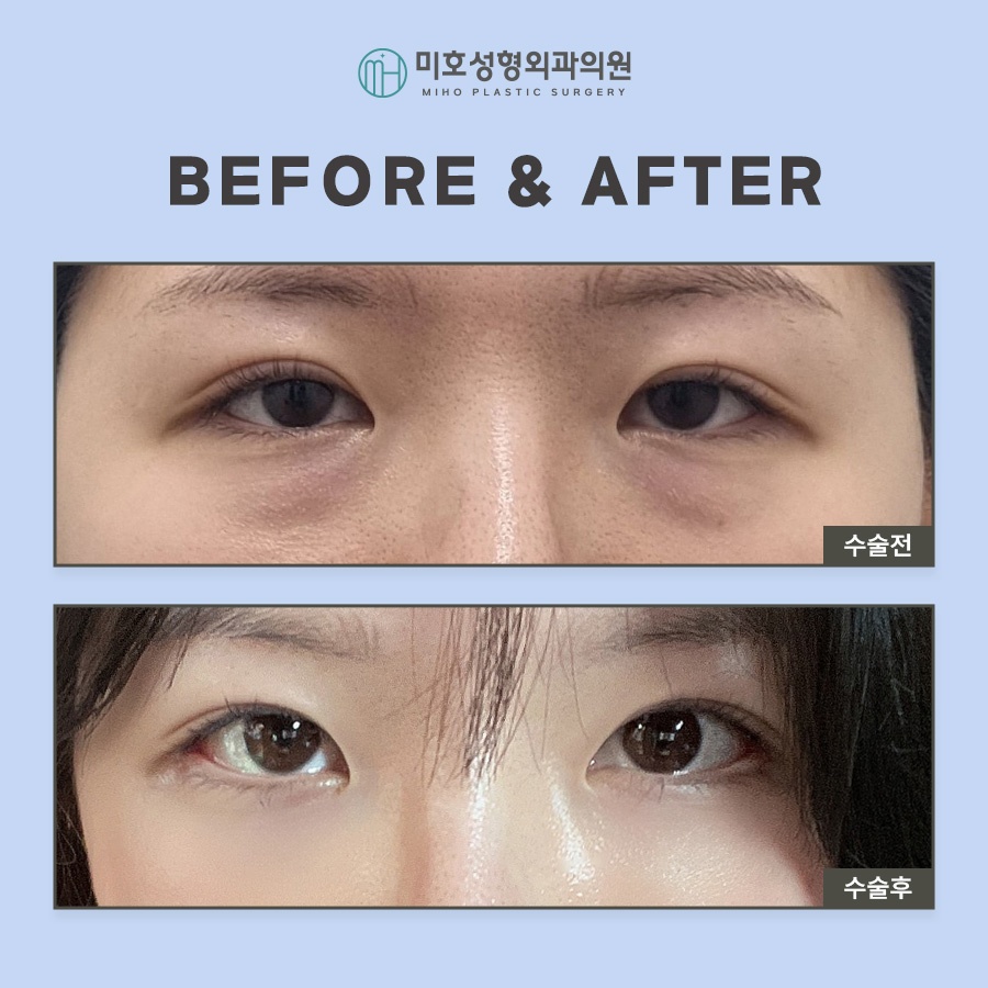 Miho Signature Lower Eyelid Fat Repositioning: The Beginning of Youth image 8