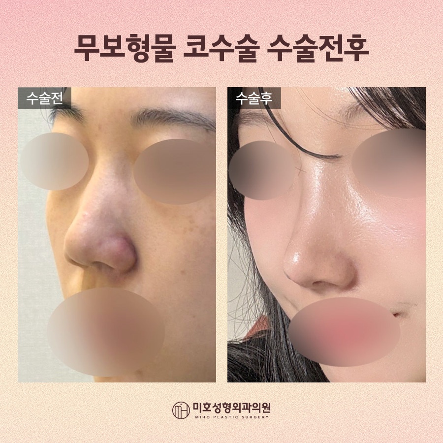 무보형물코수술 자연스레 보완하려면 관련 이미지 7