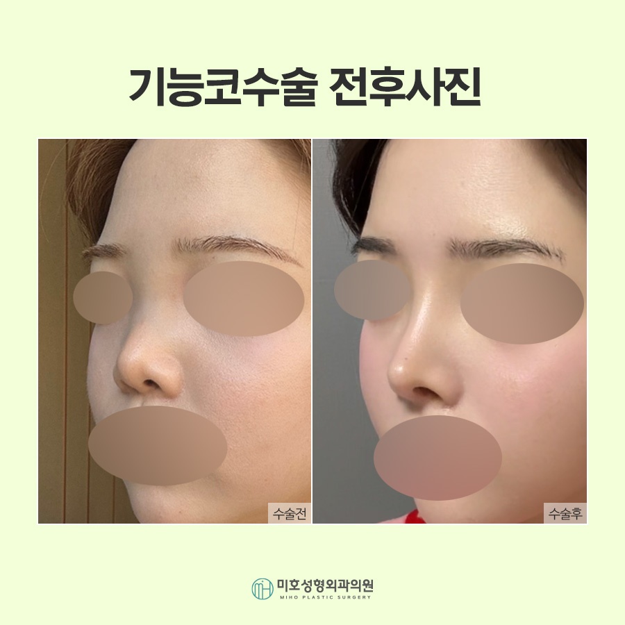 비밸브재건술 기능을 회복시키며 관련 이미지 9
