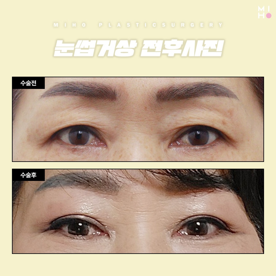 Brow Lift Review: You Could Be the Next Success Story image 9