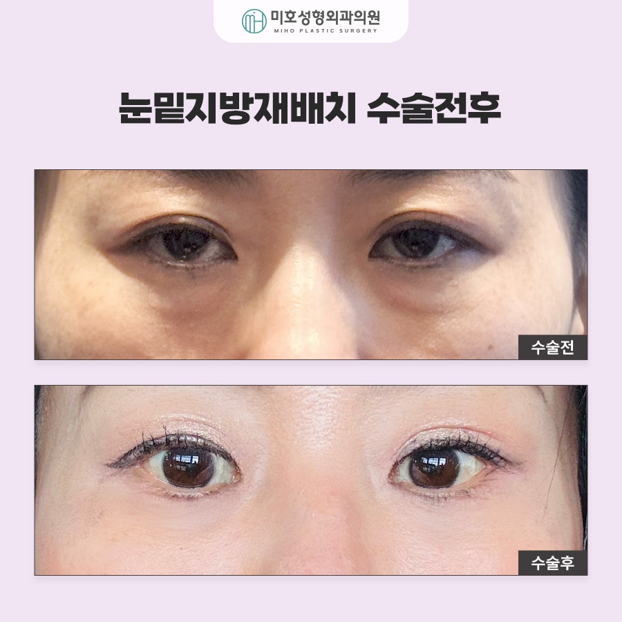 To Learn About Under-Eye Fat Graft Reviews, Methods, Swelling, and Recovery image 8