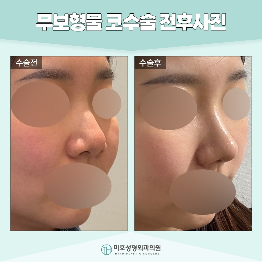 무보형물코수술 자연스러운 라인을 원한다면 관련 이미지 7
