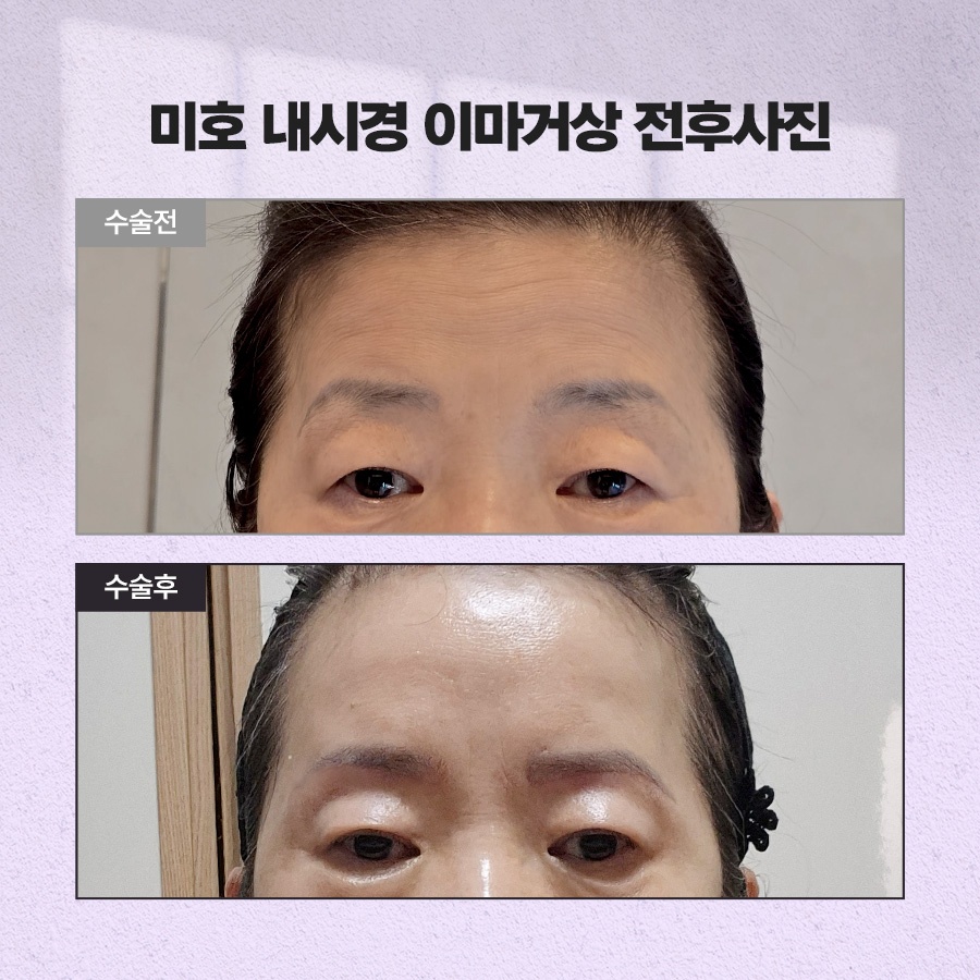 내시경이마거상 처짐 개선 원리 관련 이미지 7