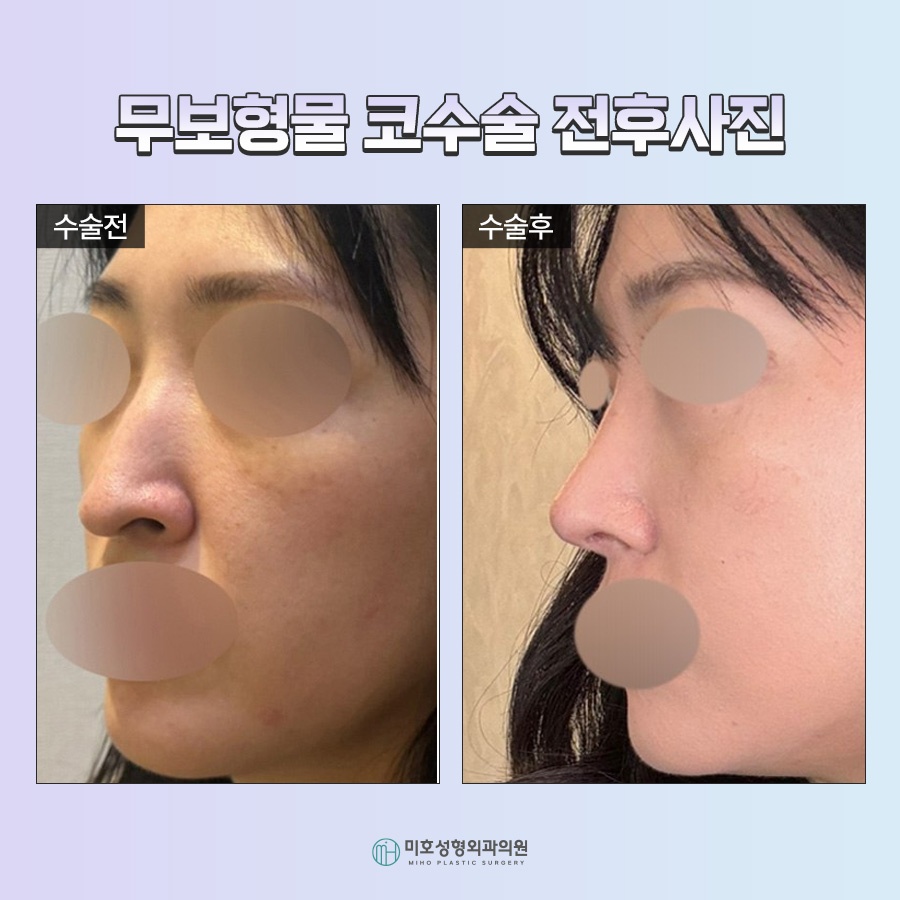 A Natural Nose Using Autologous Tissue: Implant-Free Rhinoplasty image 7
