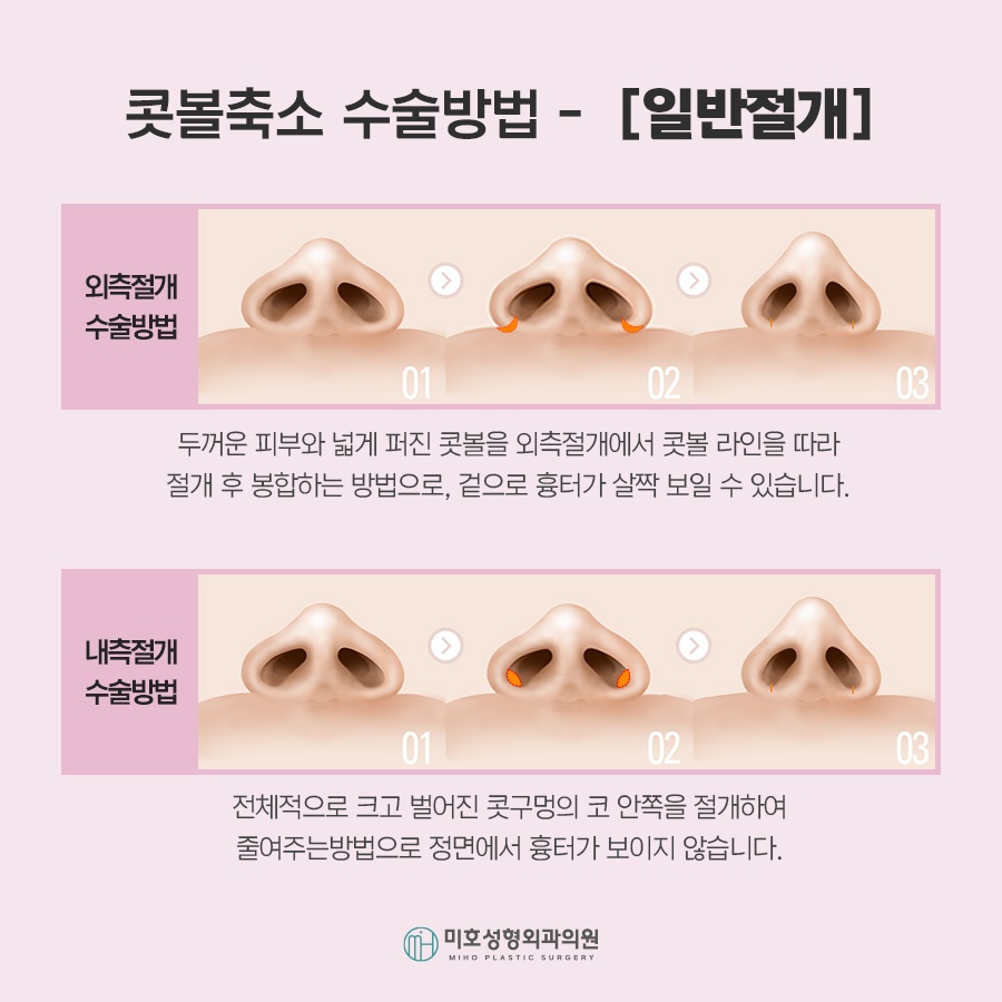 콧볼축소 자연스러운 코라인을 위한 체크포인트 관련 이미지 5