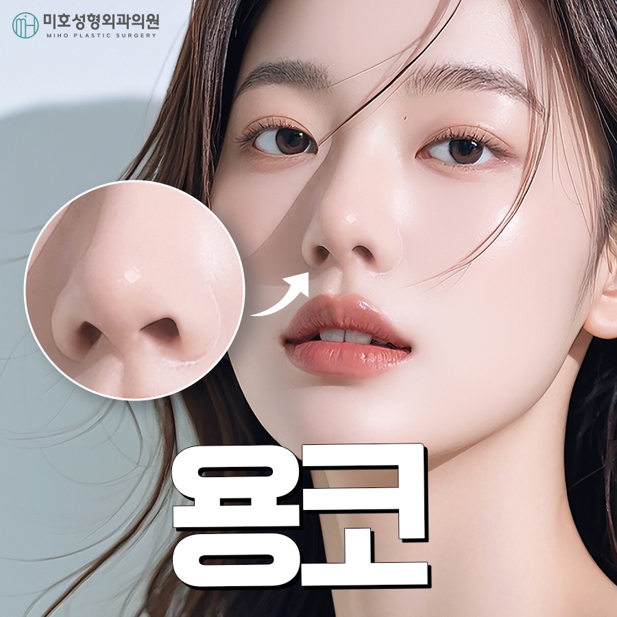 Through Drooping Nostril Correction in Bulbous Nose Surgery image 1