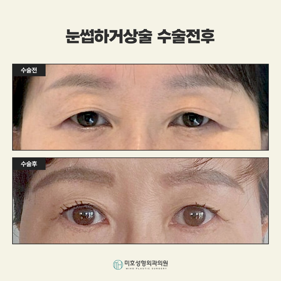 Sub-Brow Lift for Softening a Heavy Appearance image 9
