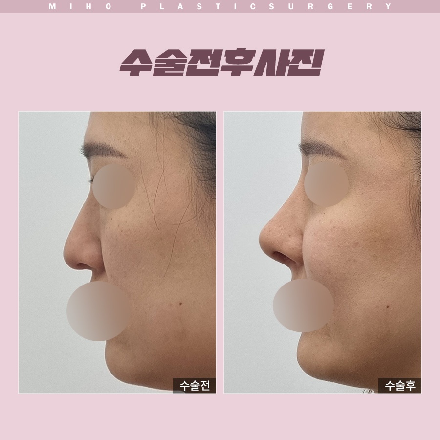 화살코 개선 전 체크리스트 6가지 관련 이미지 9