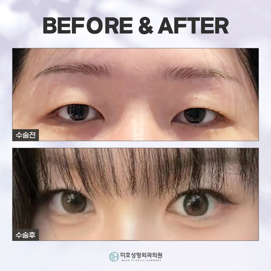 속쌍눈매교정에 관심을 두고 있다면 관련 이미지 10