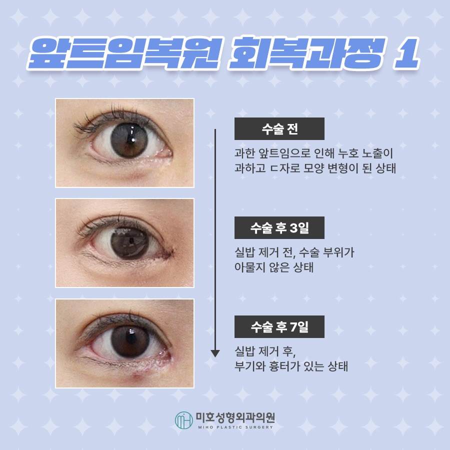 앞트임복원 제대로 알기 관련 이미지 6