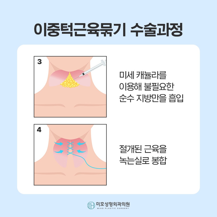 If the Jawline Beneath the Chin Looks Blurred: Double-Chin Muscle Tightening image 4