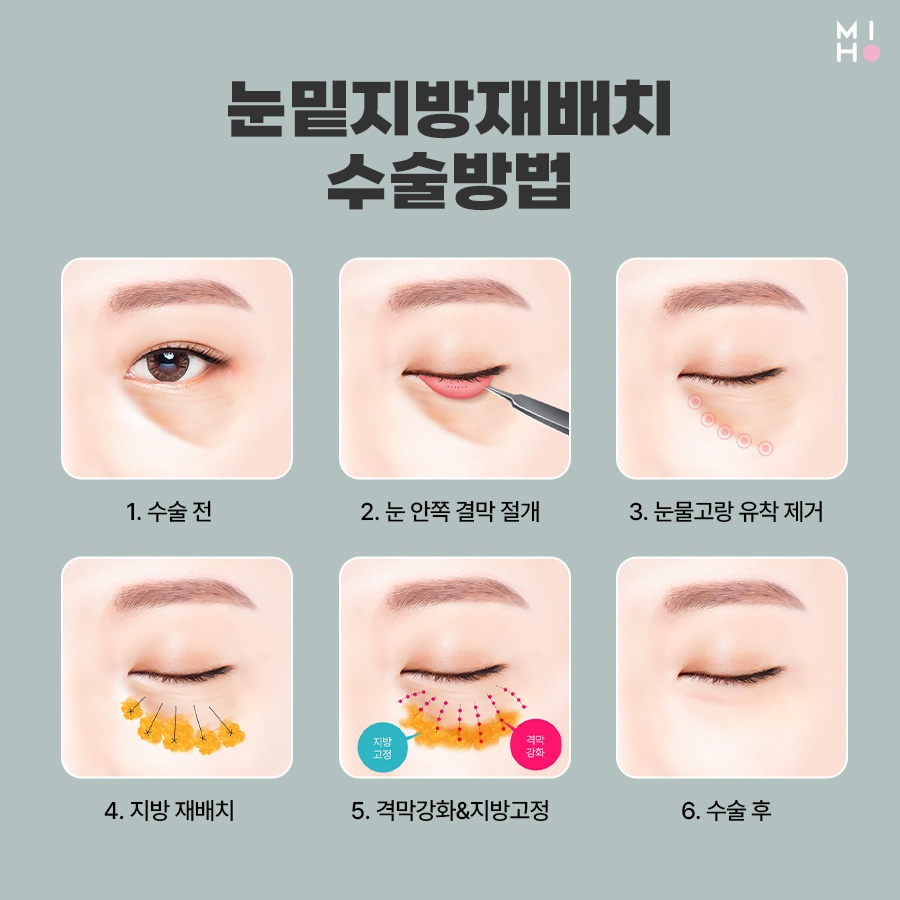 눈밑지방재배치 호감형 인상으로 개선하려면 관련 이미지 4
