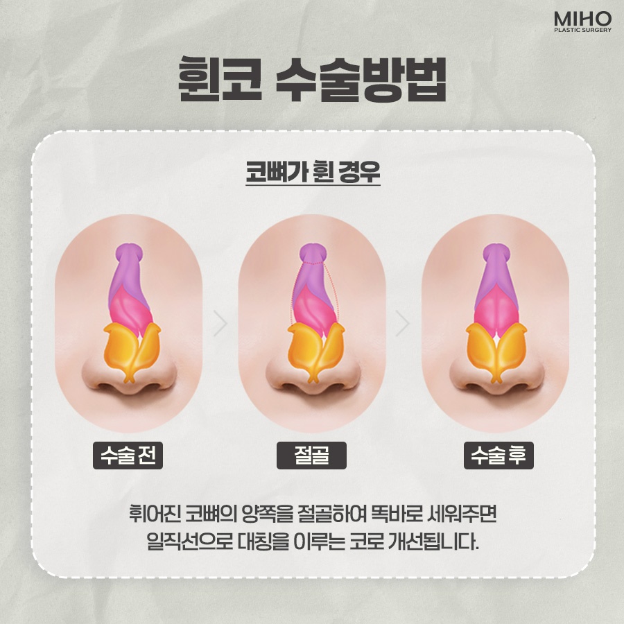 Experiencing the Difference in Crooked Nose Surgery image 5