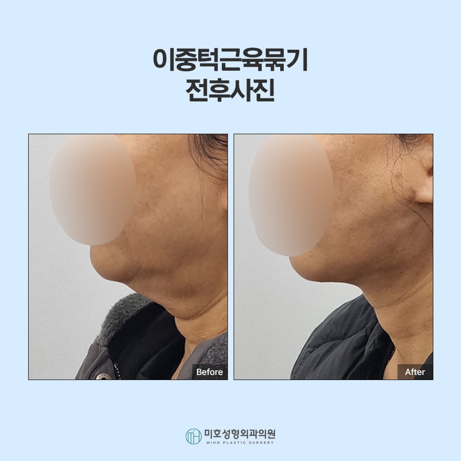 If the Jawline Beneath the Chin Looks Blurred: Double-Chin Muscle Tightening image 8