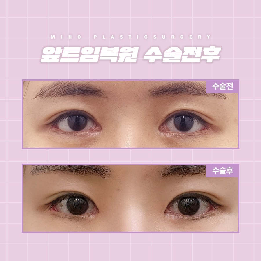 앞트임복원 새롭게 자리 잡도록 관련 이미지 8