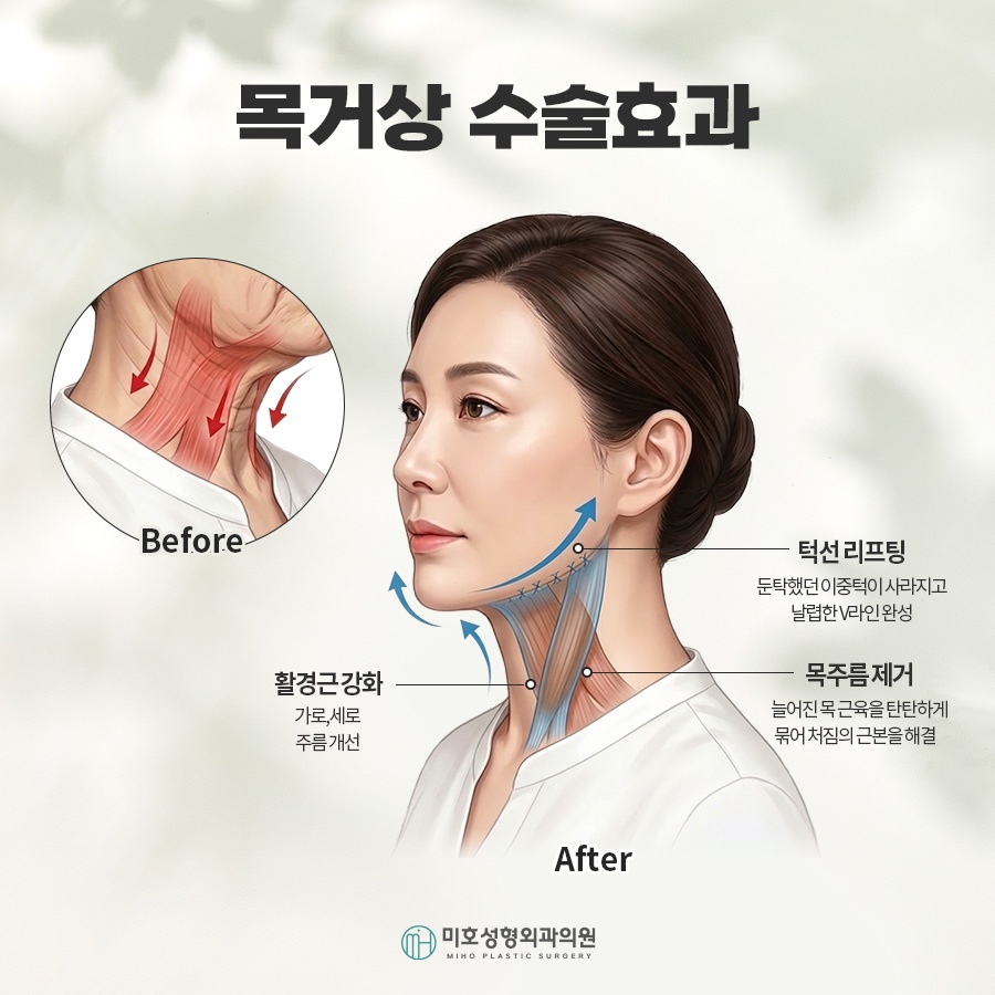 Neck Lift: A Lifting Method to Restore a Sagging Neckline image 3