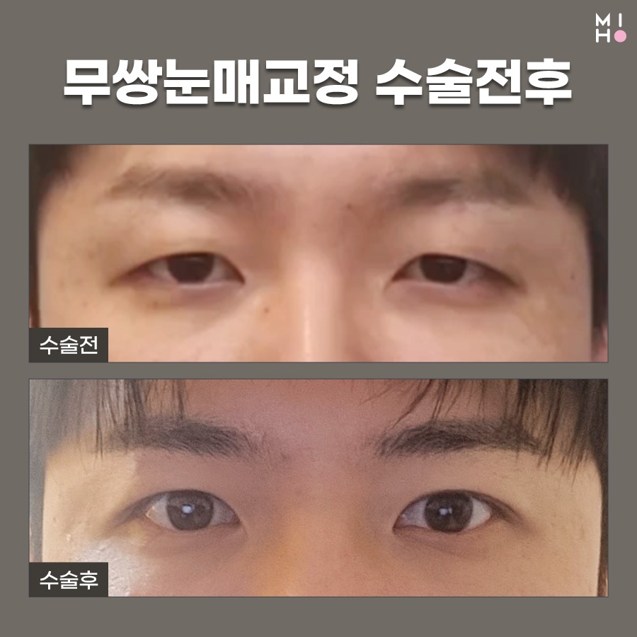 무쌍눈매교정 상황에 따른 개선법 관련 이미지 9