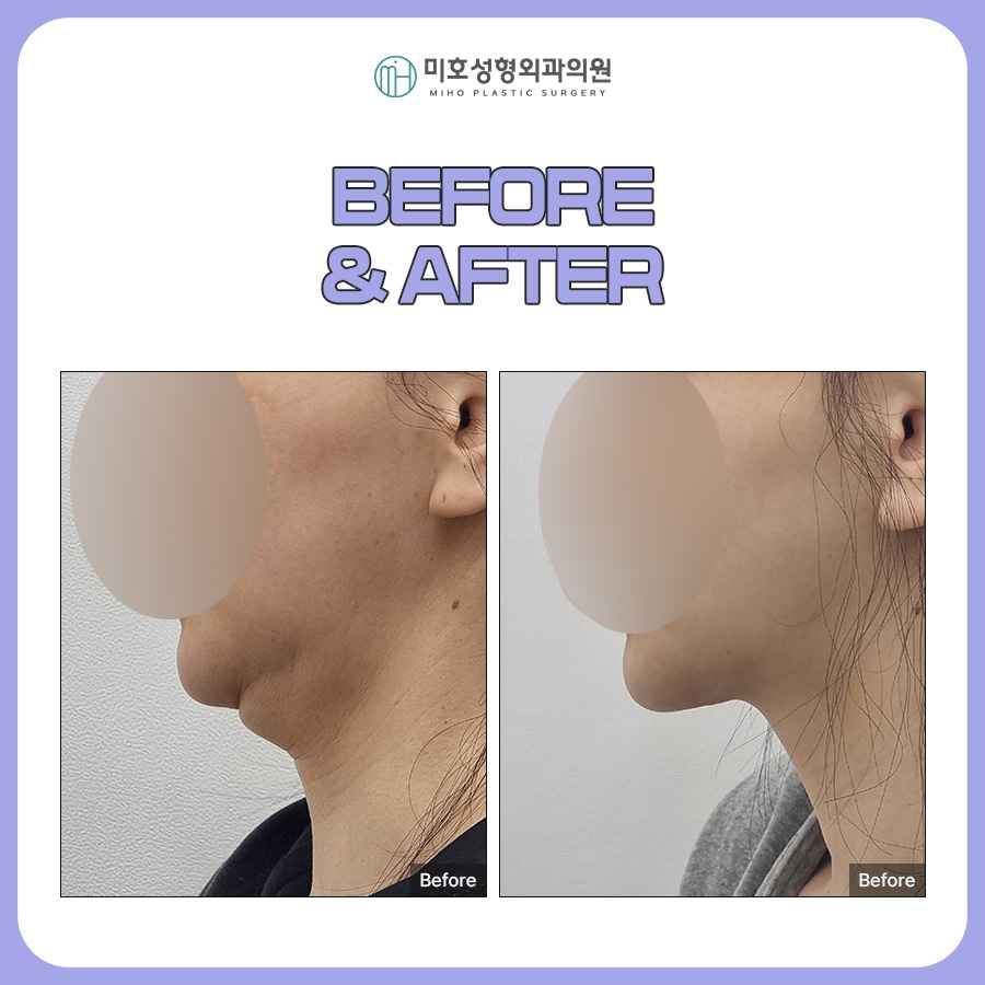 Looking at the Progress of Chin Muscle Ligation for a Double Chin image 7