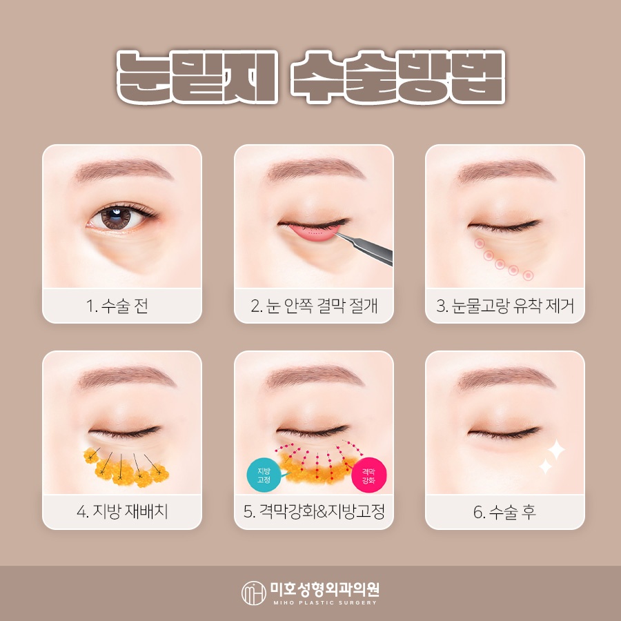 눈밑지붓기 원인 기간을 고려하여 관련 이미지 5