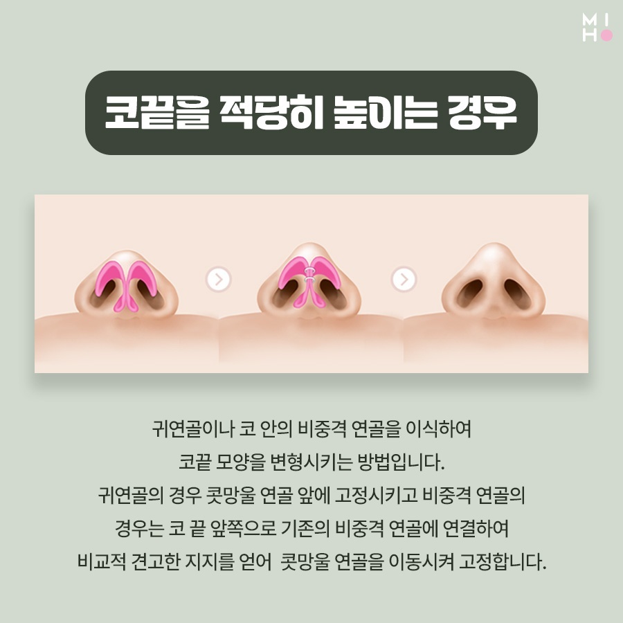 코끝연골묶기 복코 교정을 위한 과정 관련 이미지 6