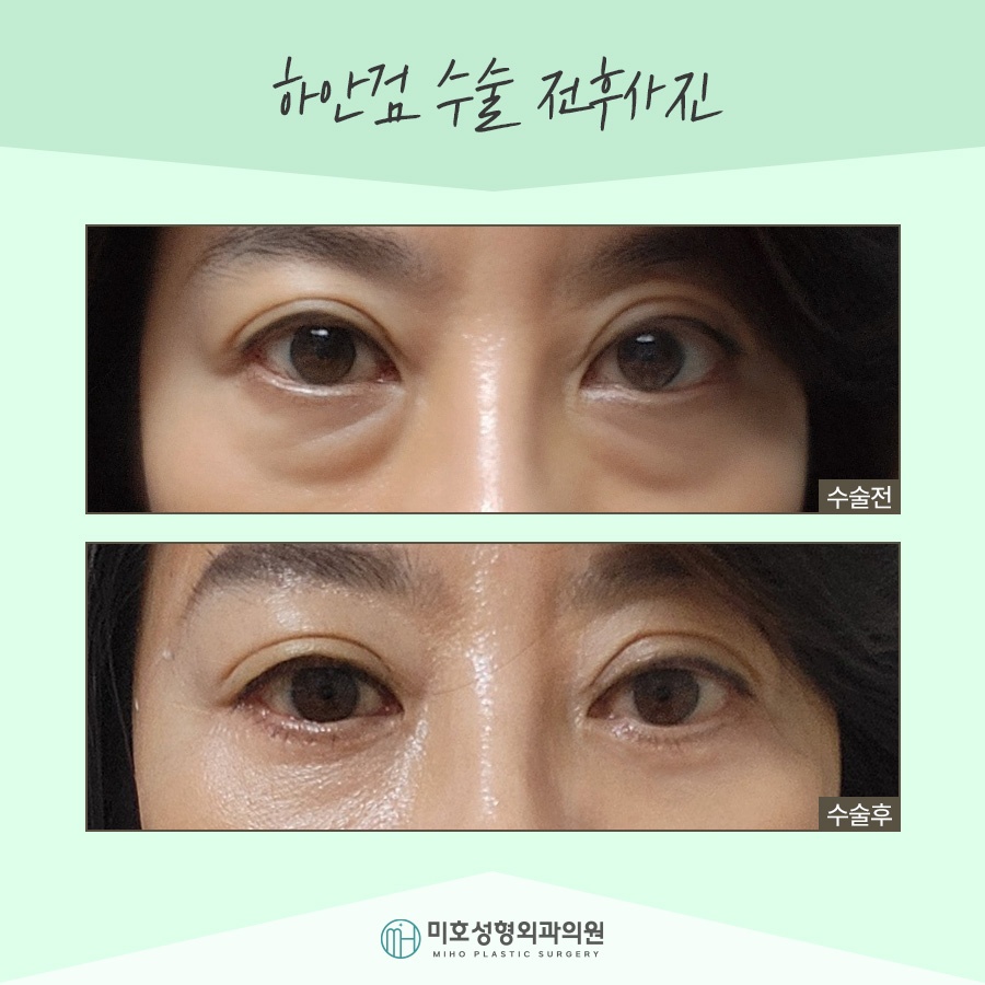 If Lower Blepharoplasty Is Needed for Drooping Eyes image 8