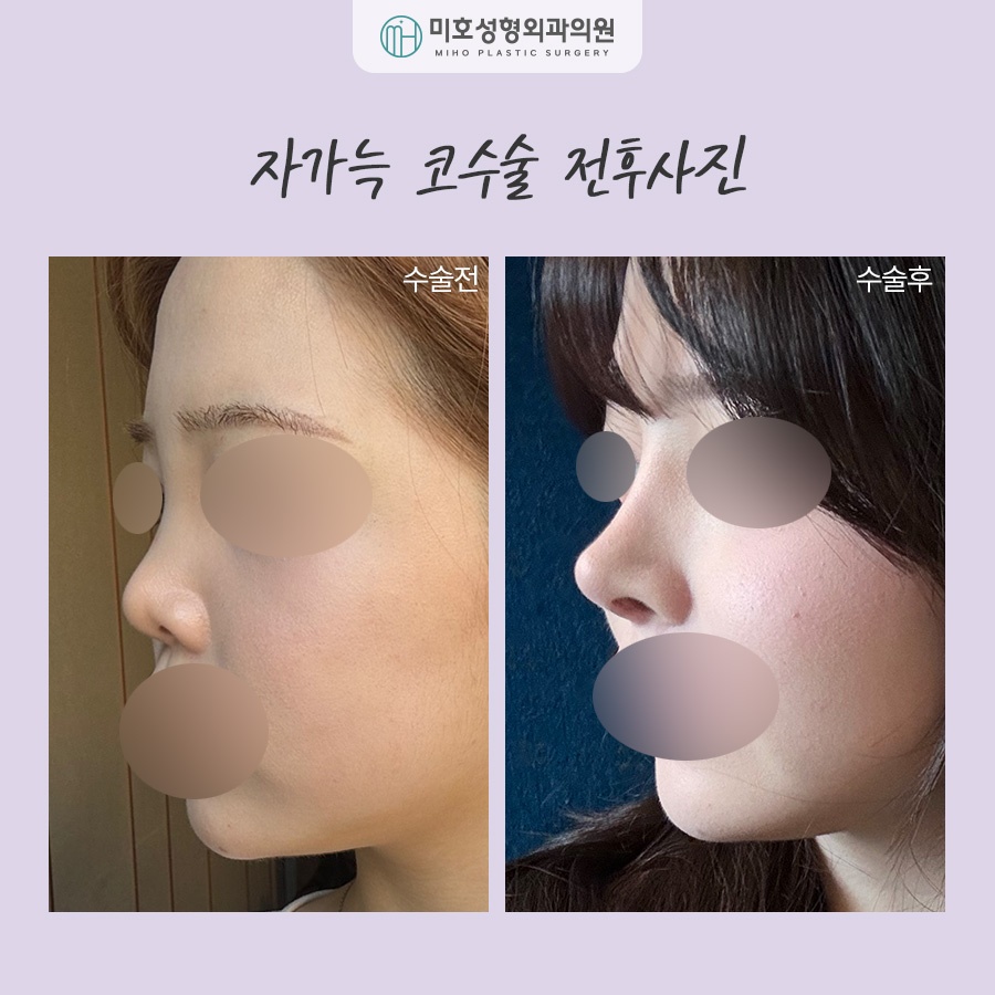 For a Natural-Looking Result with Costal Cartilage Nose Surgery image 7