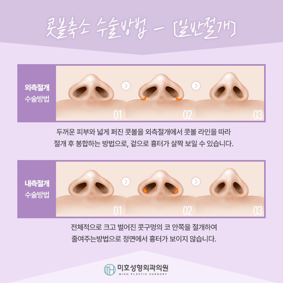 Nasal Alar Reduction in a Natural Direction image 5