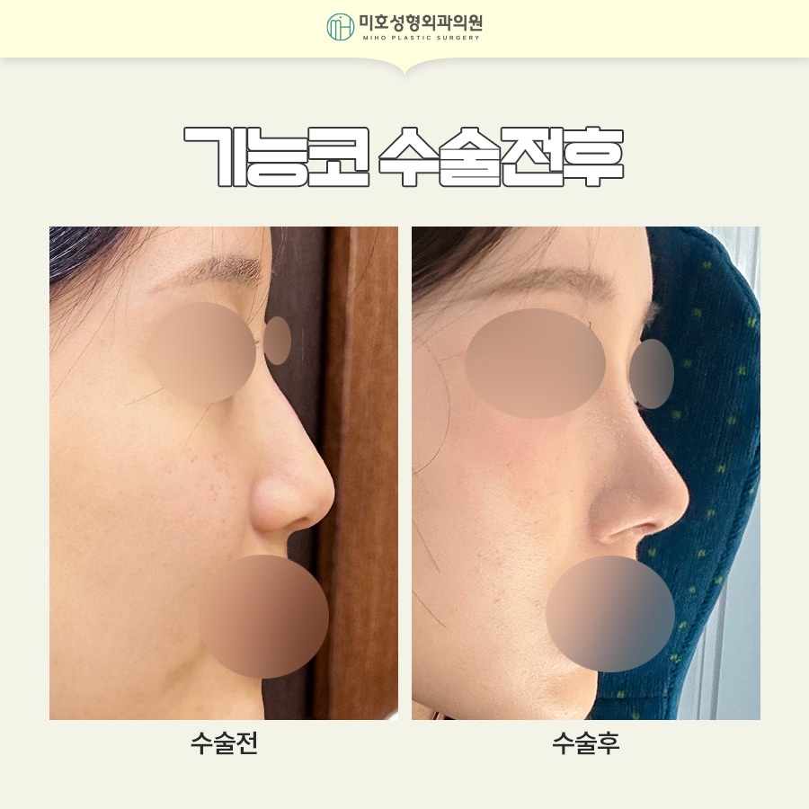 If You're Curious About Who Is Recommended for Nasal Valve Reconstruction and the Recovery Period image 9