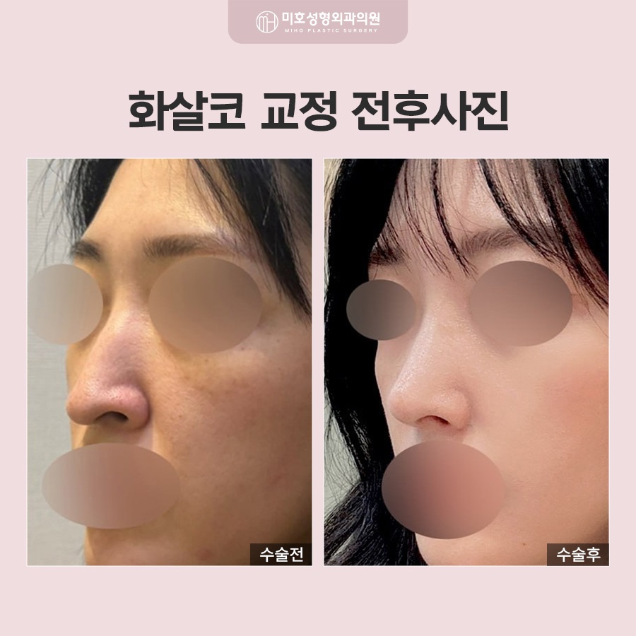 화살코 형태의 원인과 개선 방법 관련 이미지 6