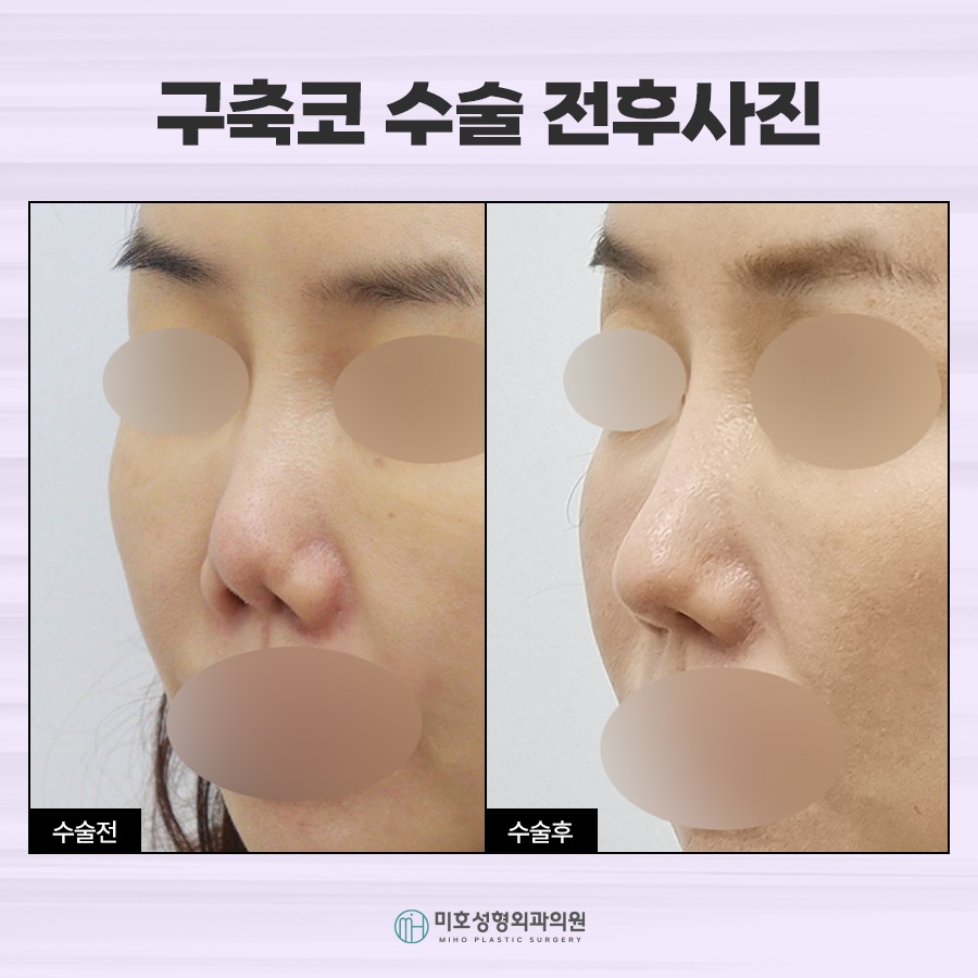 If You Need Contracted Nose Reconstruction image 9