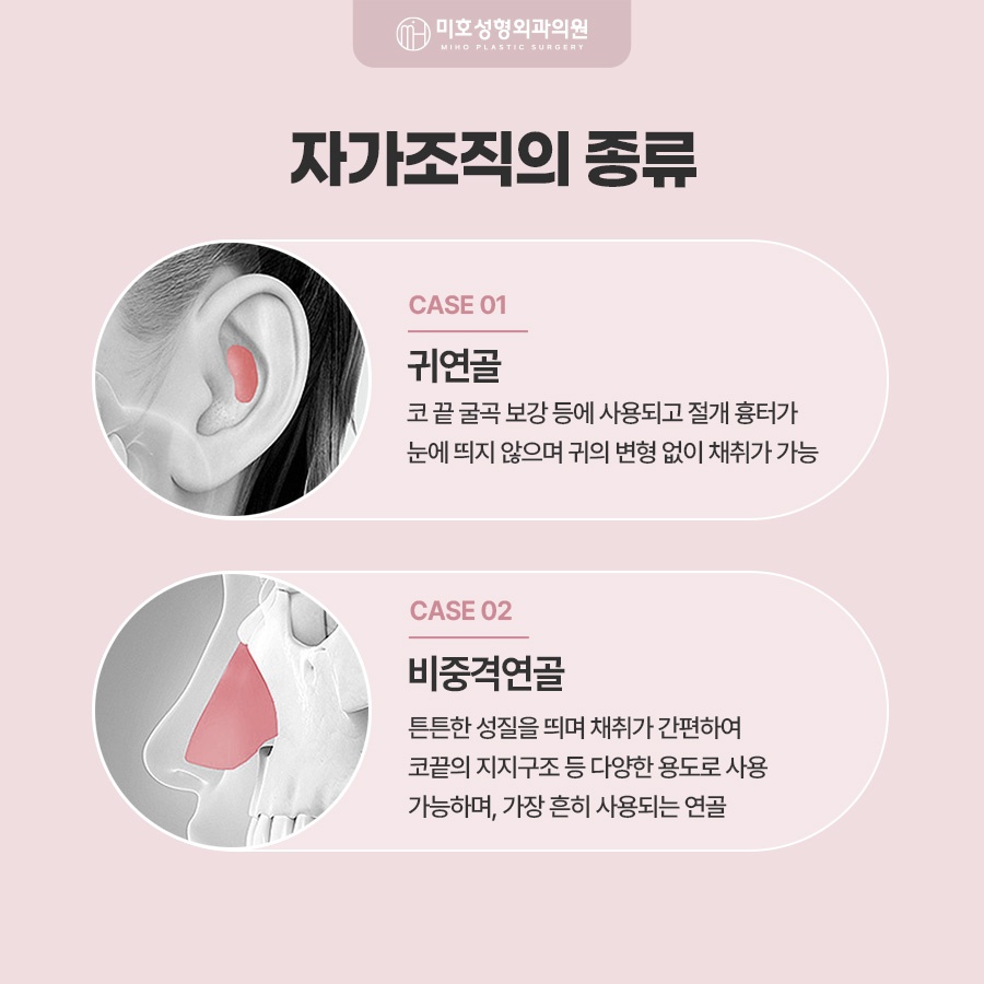 구축코재수술 코끝이 들리고 짧아졌다면 확인해야 할 것 관련 이미지 3
