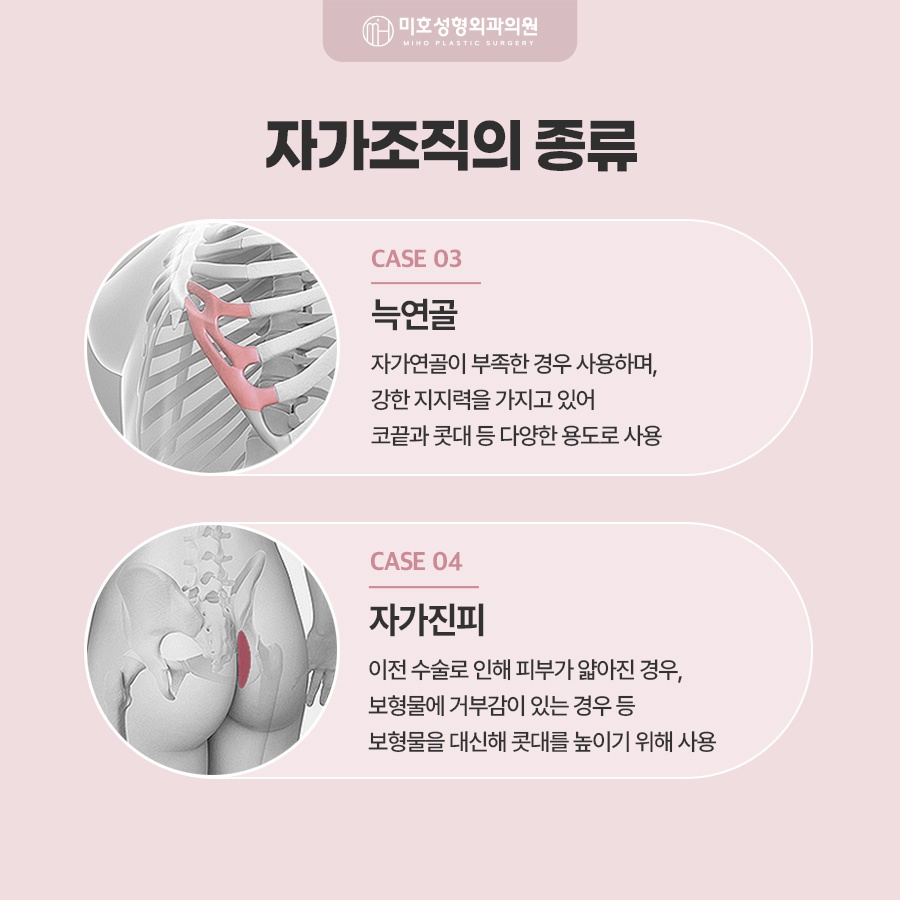 구축코재수술 코끝이 들리고 짧아졌다면 확인해야 할 것 관련 이미지 4