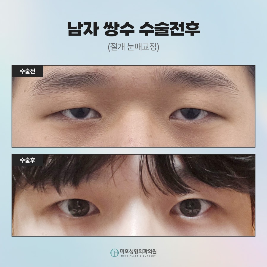 What Men Considering Double Eyelid Surgery Should Know image 7