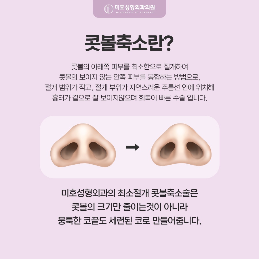 콧볼축소 고려 유형과 방식 관련 이미지 2