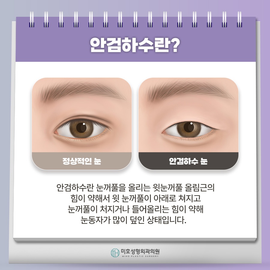 남자안검하수 자연스러움을 바탕으로 관련 이미지 2
