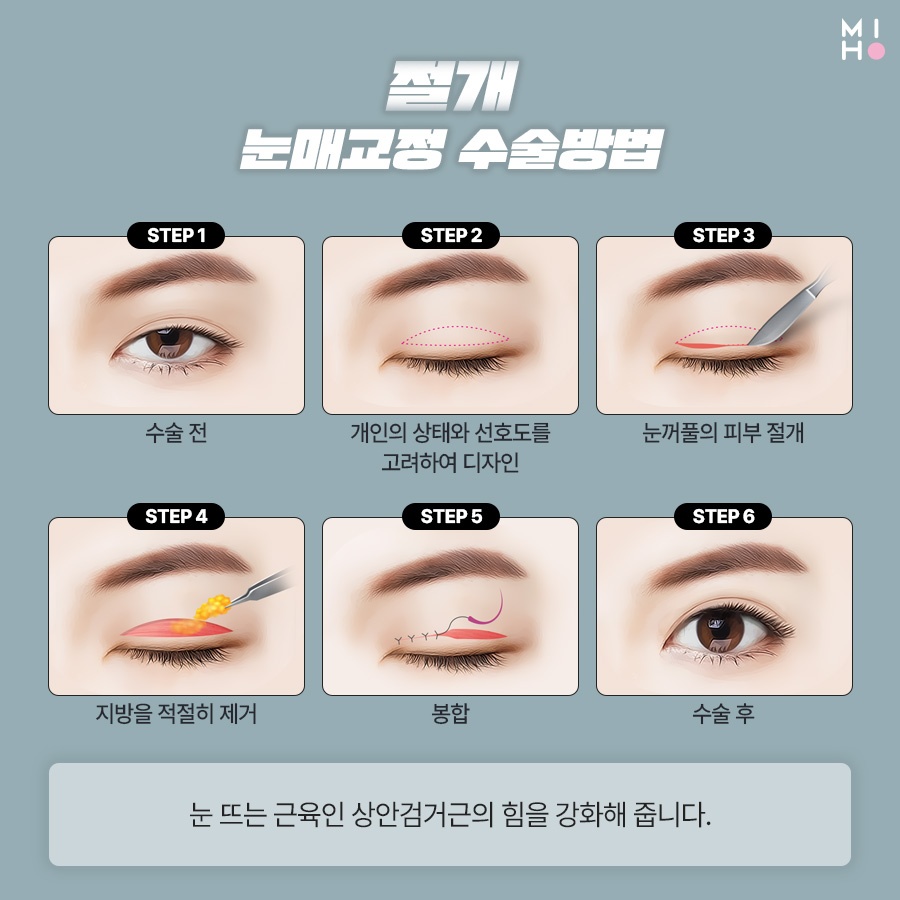 남자눈매교정 무쌍부터 유쌍까지 시원하게 관련 이미지 5