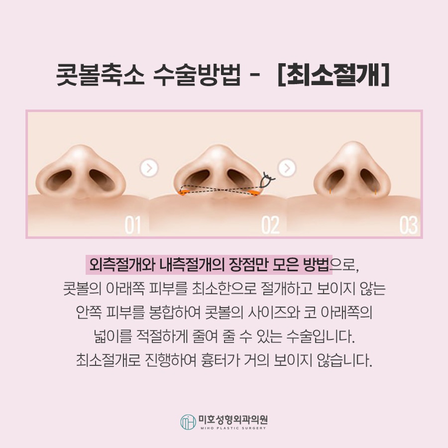 콧볼축소 자연스러운 코라인을 위한 체크포인트 관련 이미지 6