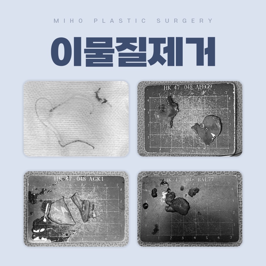 Delicate and Safe Foreign-Body Removal and Nasal Reconstruction image 1