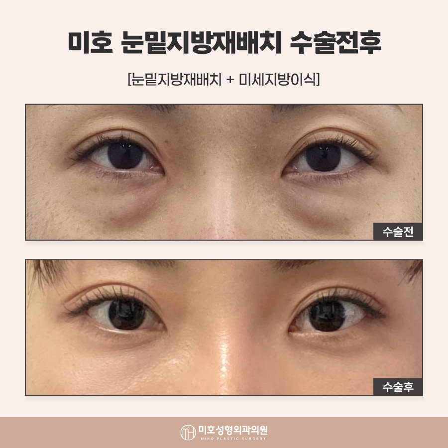 눈밑지방재배치수술후 회복 흐름 살펴봐야 관련 이미지 10