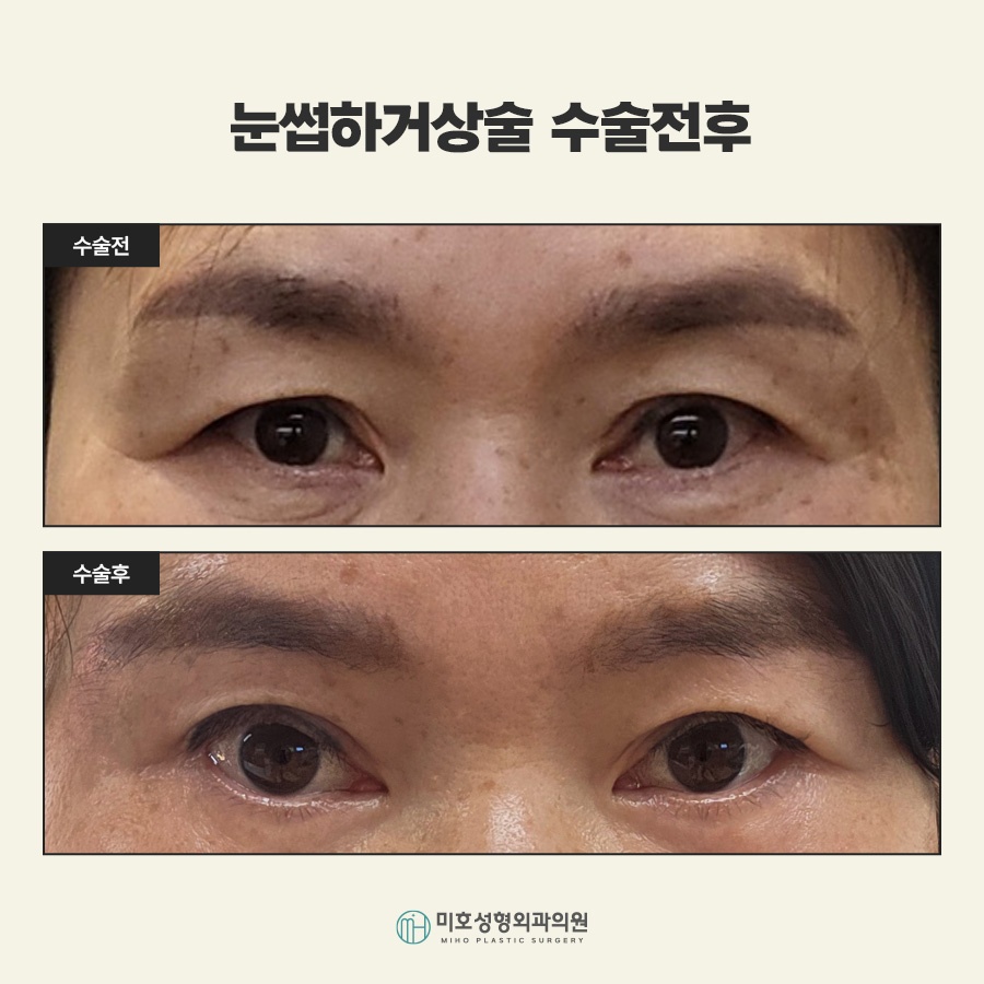 Sub-Brow Lift for Softening a Heavy Appearance image 10