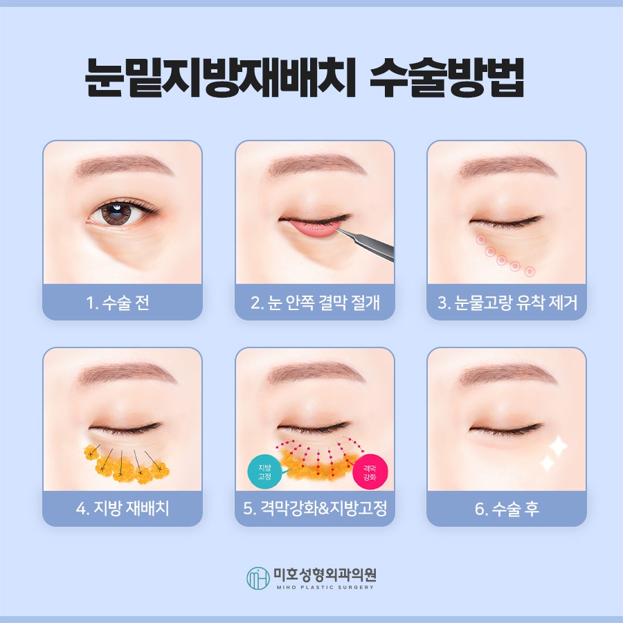 눈밑지 다크서클 처짐 고민된다면 관련 이미지 6