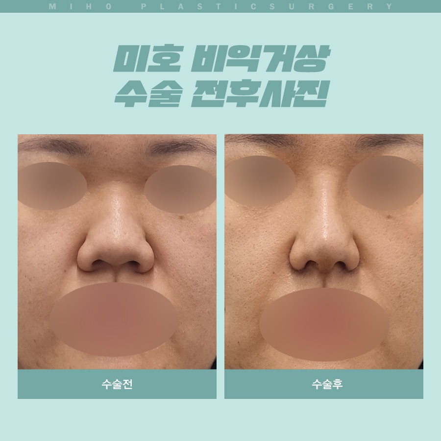 Creating a Naturally Refined Nose with an Alar Lift image 9