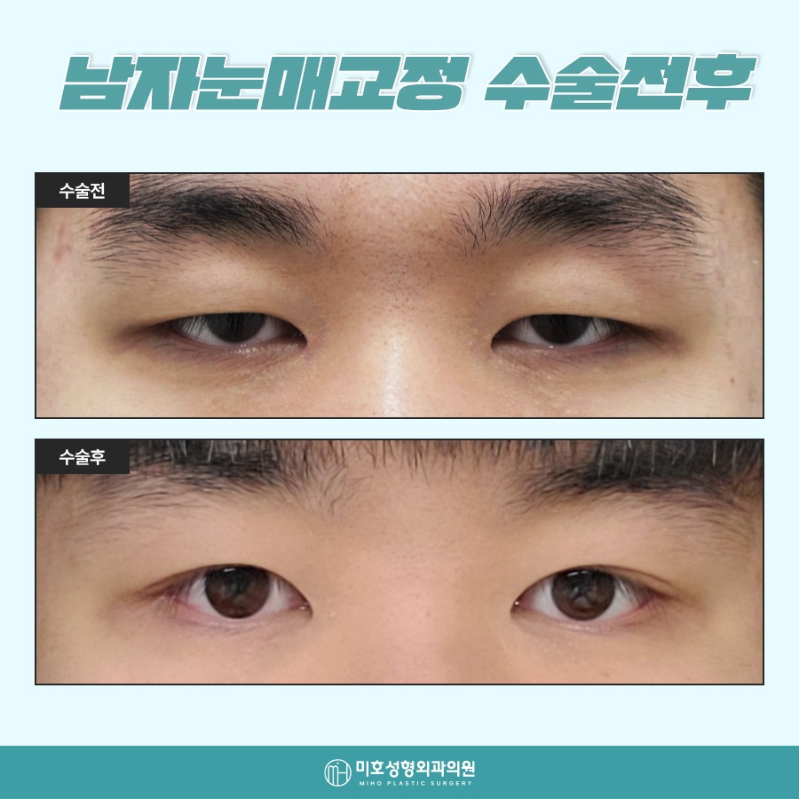 Natural-Looking Male Eye Shape Correction image 10