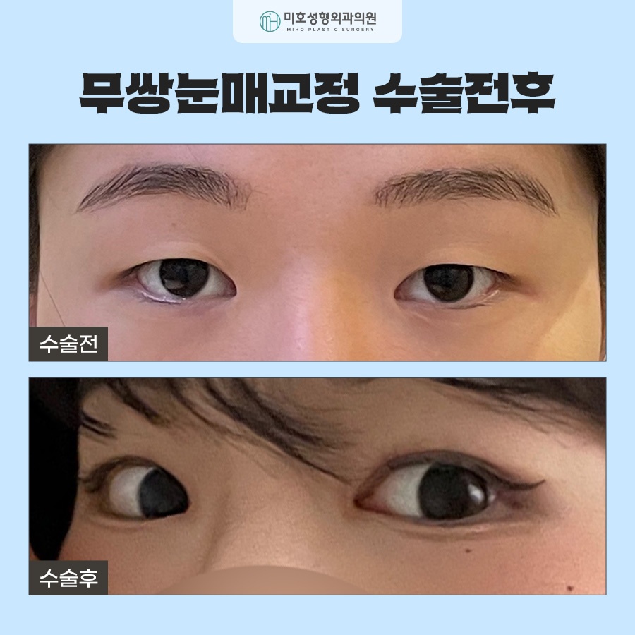 무쌍눈매교정 전후 차이를 비교해보고 관련 이미지 7