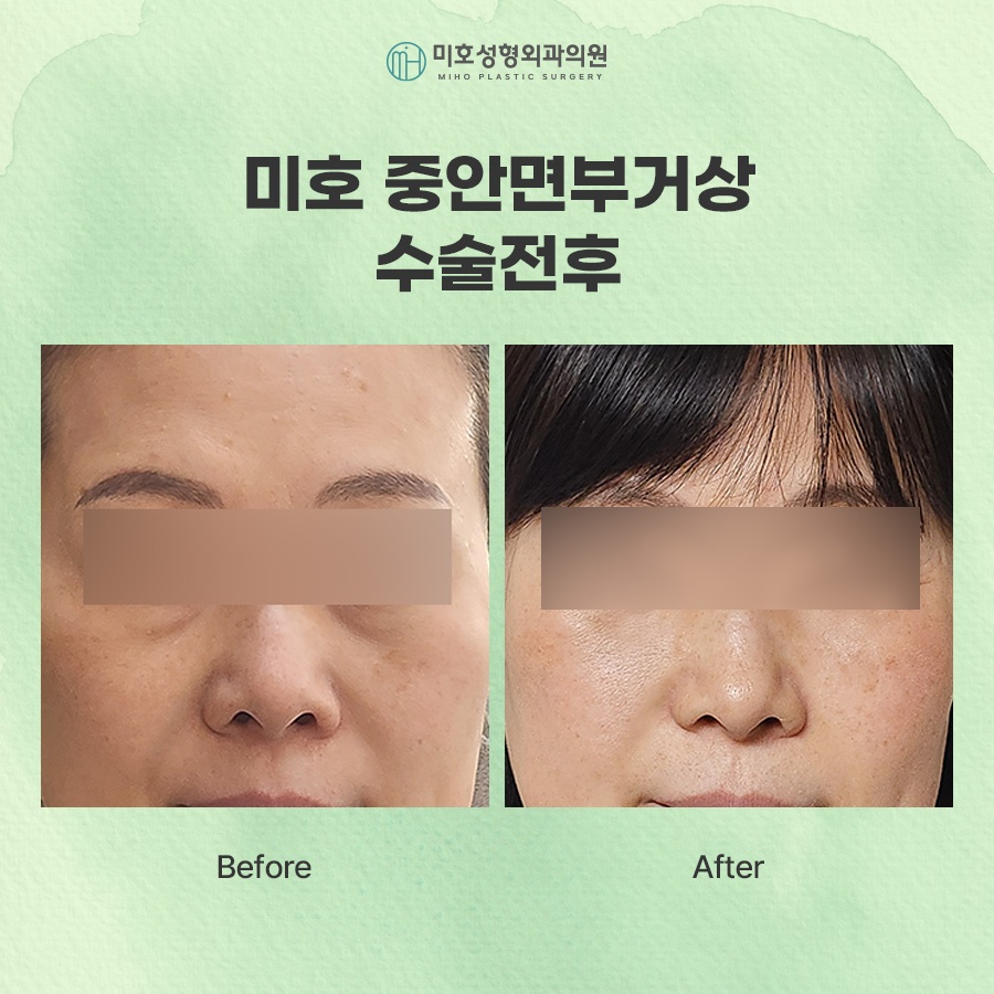중안면거상 노화 증상에 주목하여 관련 이미지 7
