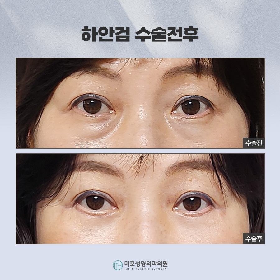 An In-Depth Analysis of Upper and Lower Blepharoplasty image 9