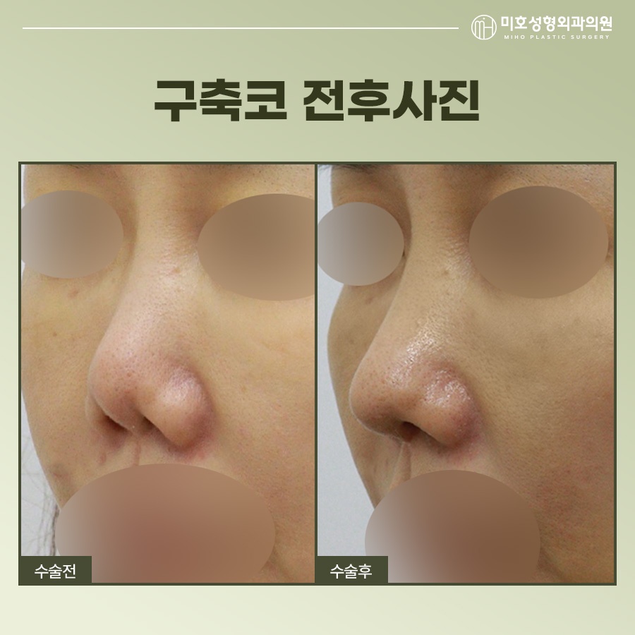 Identify the Cause of a Contracted Nose Before Attempting Revision image 11